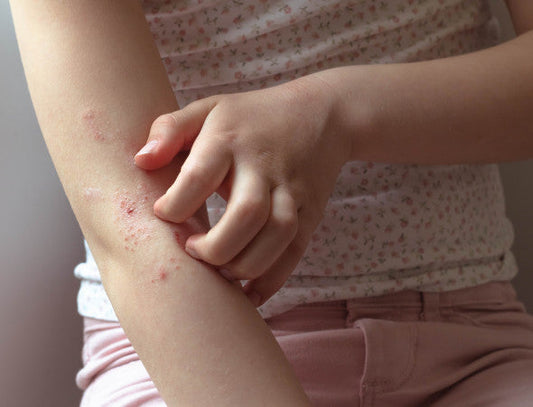 Peau à tendance atopique : on dit stop aux peaux douloureuses
